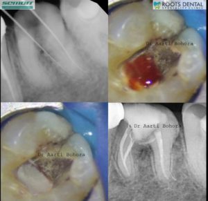 A referred case of Management of perforation in 36.